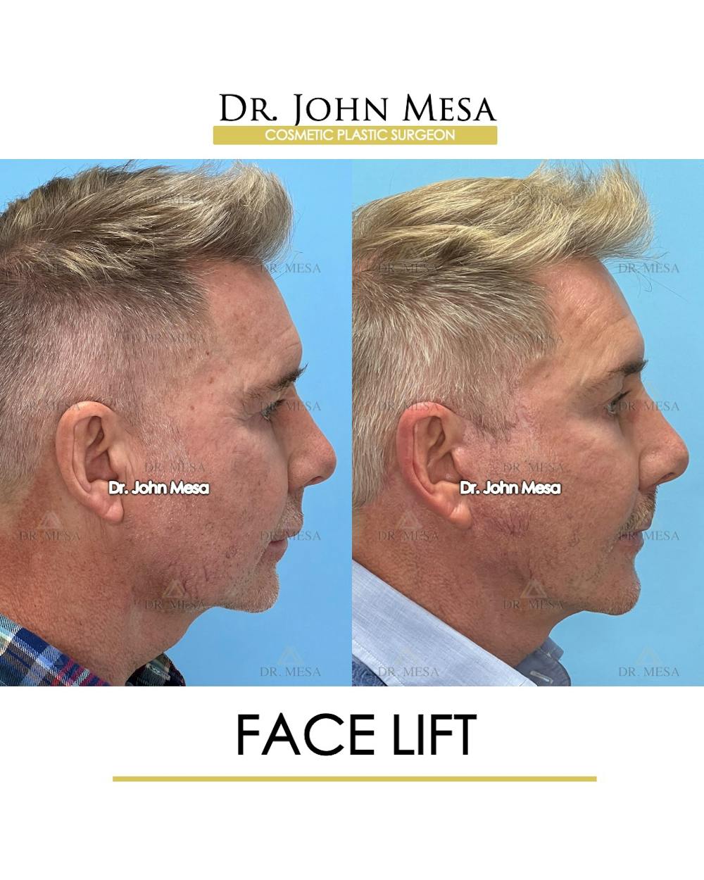 Facelift Before & After Gallery - Patient 148735216 - Image 3