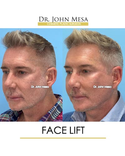Facelift Before & After Gallery - Patient 148735216 - Image 4