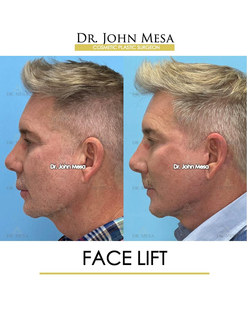 Facelift Before & After Gallery - Patient 148735216 - Image 5