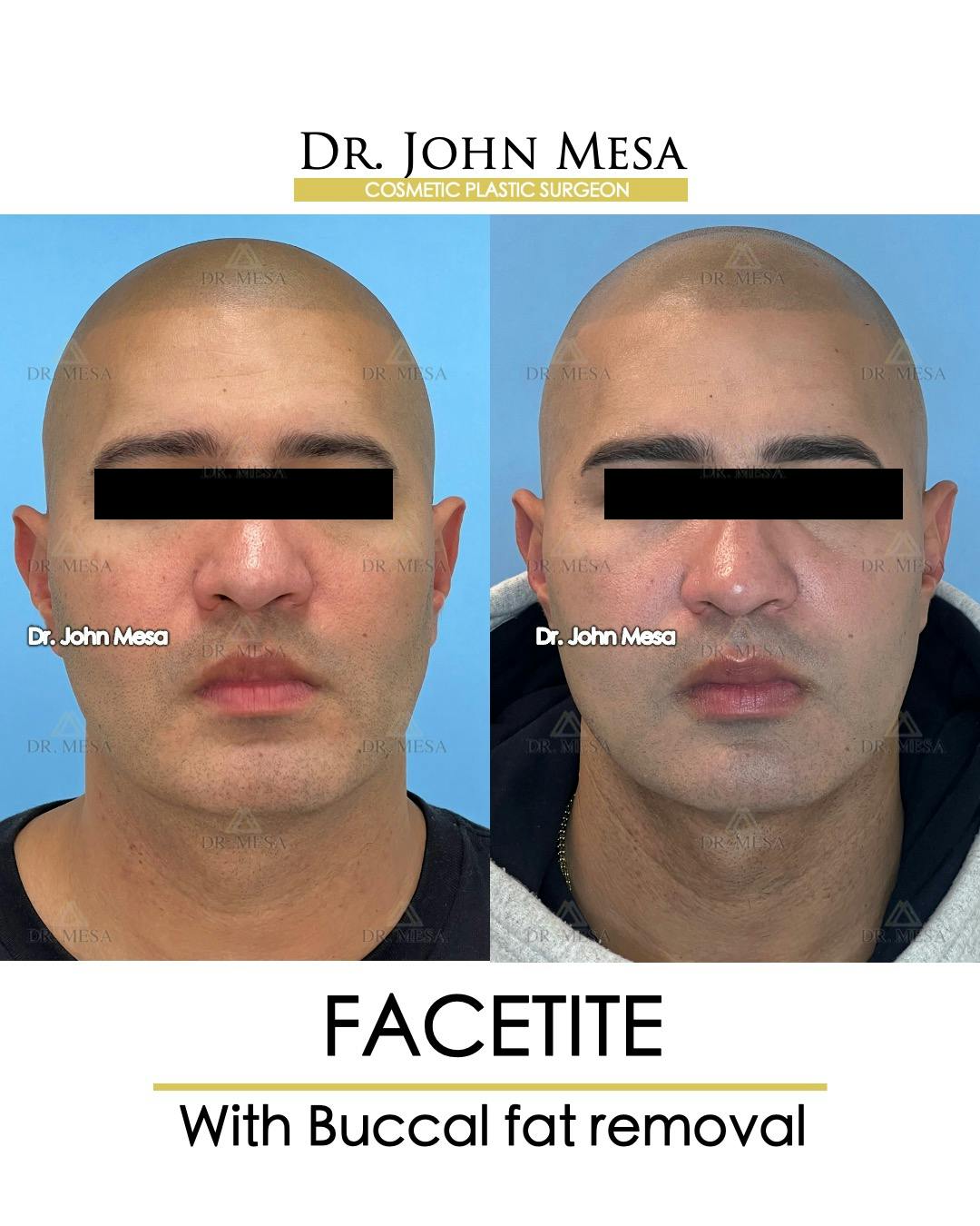 FaceTite Before & After Gallery - Patient 148735304 - Image 1