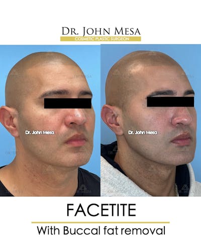 FaceTite Before & After Gallery - Patient 148735304 - Image 2