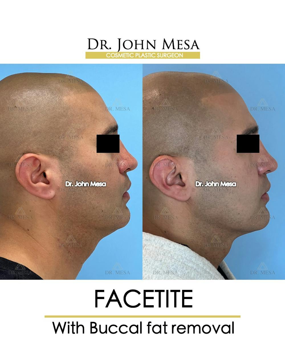 FaceTite Before & After Gallery - Patient 148735304 - Image 3