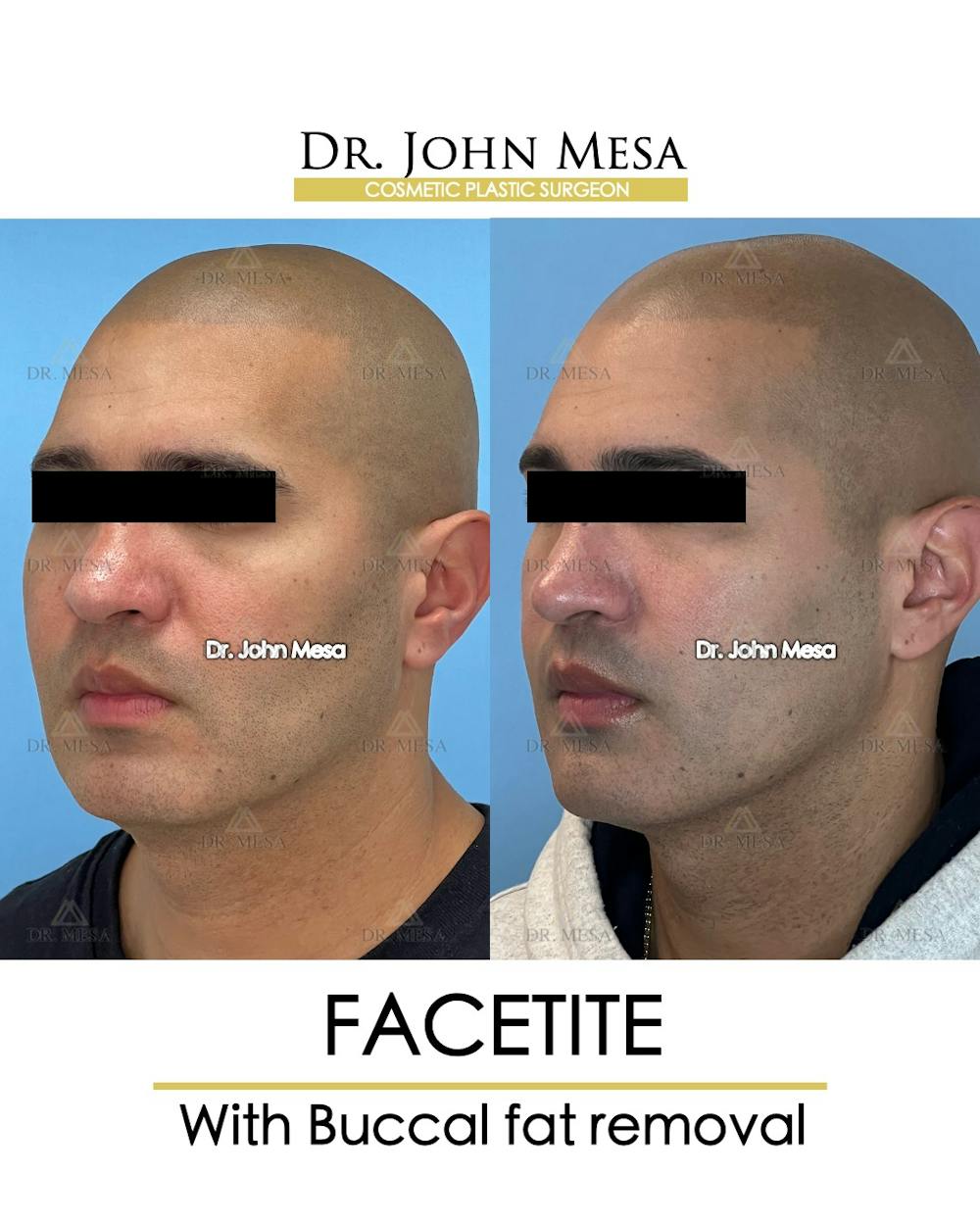 FaceTite Before & After Gallery - Patient 148735304 - Image 4