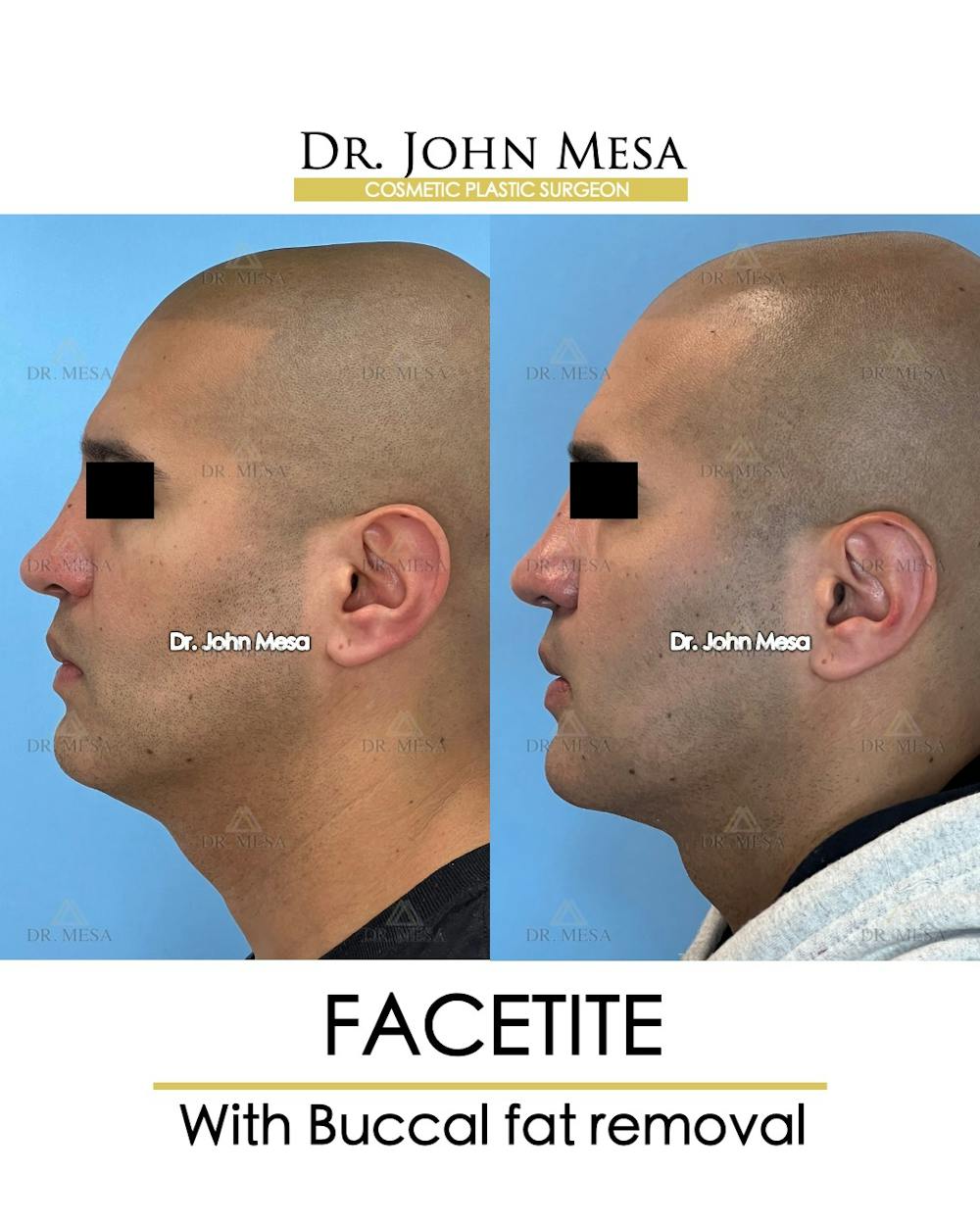FaceTite Before & After Gallery - Patient 148735304 - Image 5