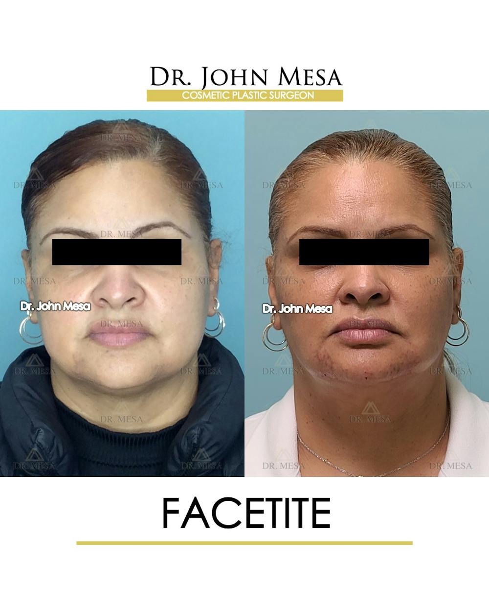 FaceTite Before & After Gallery - Patient 148735293 - Image 1