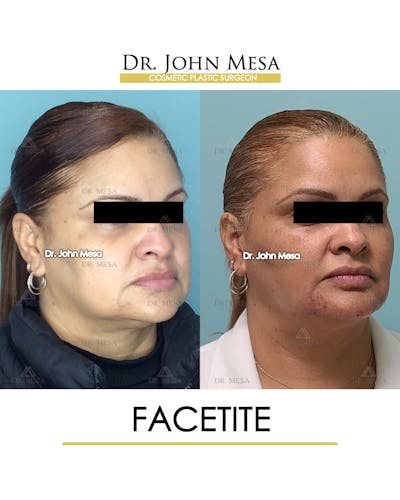FaceTite Before & After Gallery - Patient 148735293 - Image 2