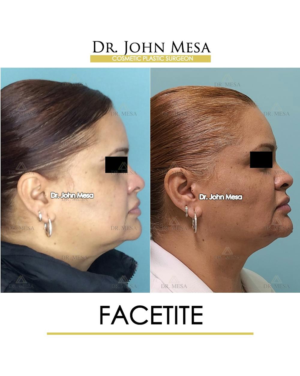 FaceTite Before & After Gallery - Patient 148735293 - Image 3