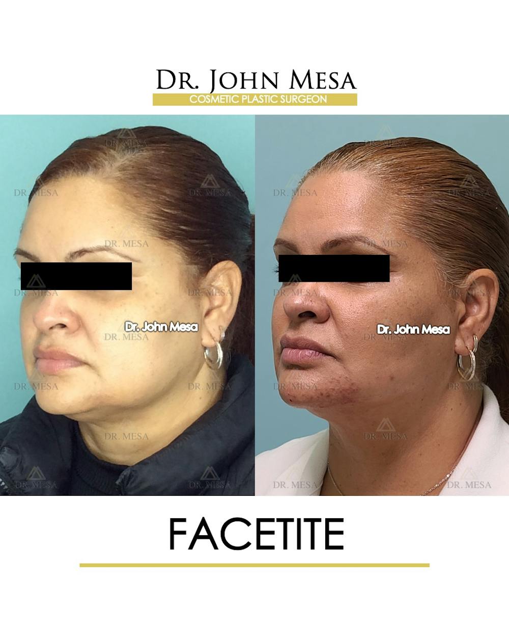 FaceTite Before & After Gallery - Patient 148735293 - Image 4