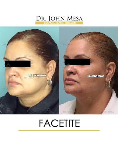 FaceTite Before & After Gallery - Patient 148735293 - Image 4