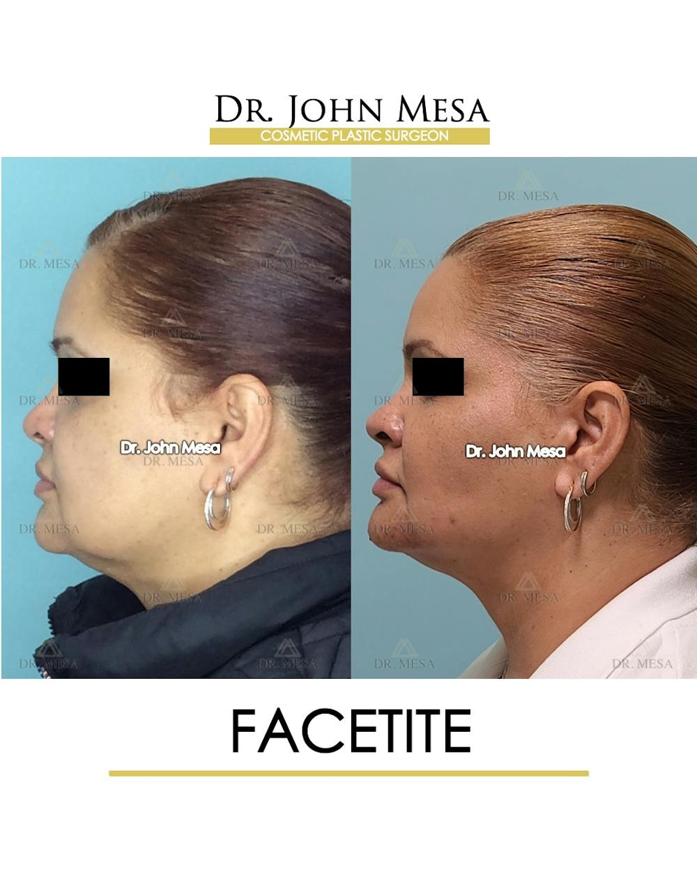 FaceTite Before & After Gallery - Patient 148735293 - Image 5