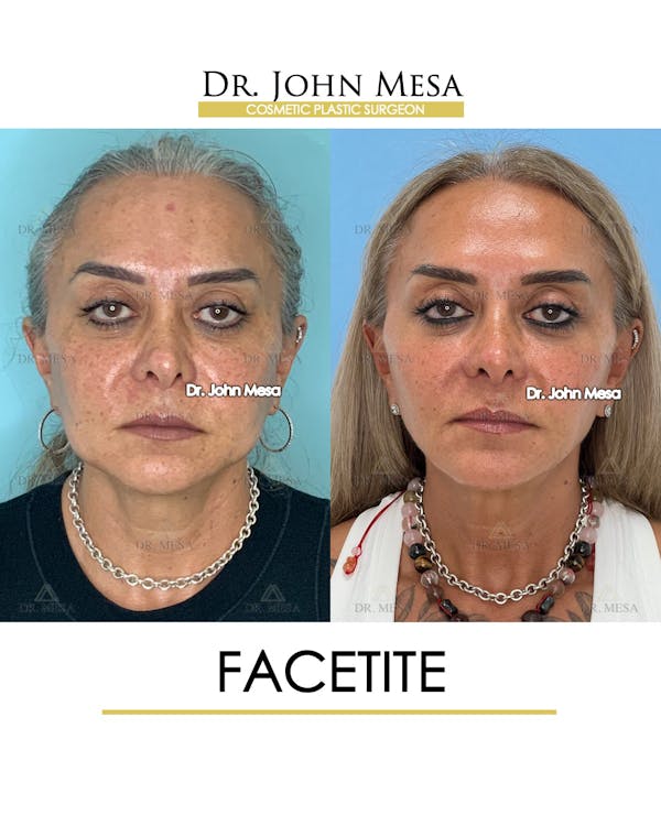 FaceTite Before & After Gallery - Patient 148735294 - Image 1