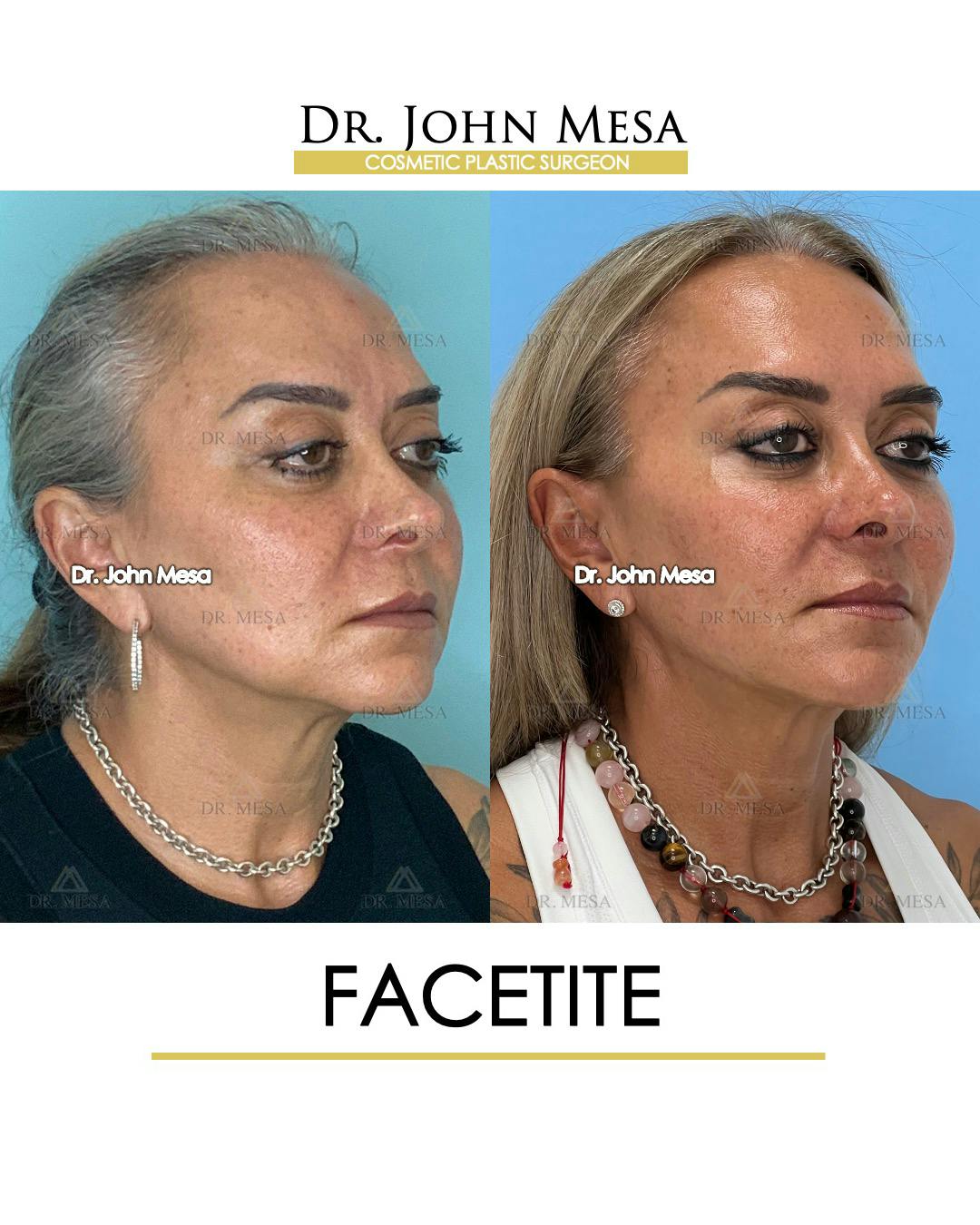 FaceTite Before & After Gallery - Patient 148735294 - Image 2