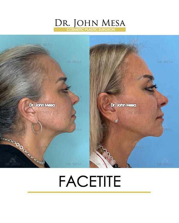 FaceTite Before & After Gallery - Patient 148735294 - Image 3