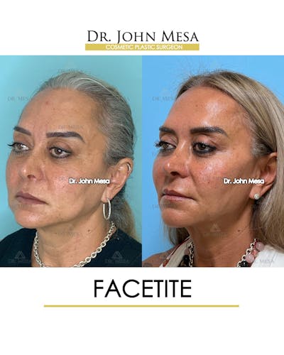 FaceTite Before & After Gallery - Patient 148735294 - Image 4