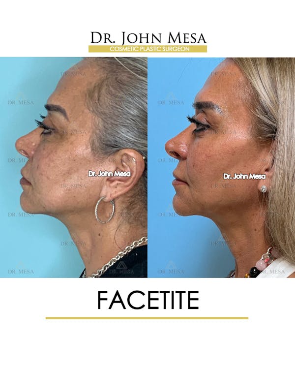 FaceTite Before & After Gallery - Patient 148735294 - Image 5