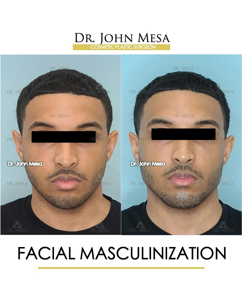 Facial Masculinization Before & After Gallery - Patient 148735313 - Image 1