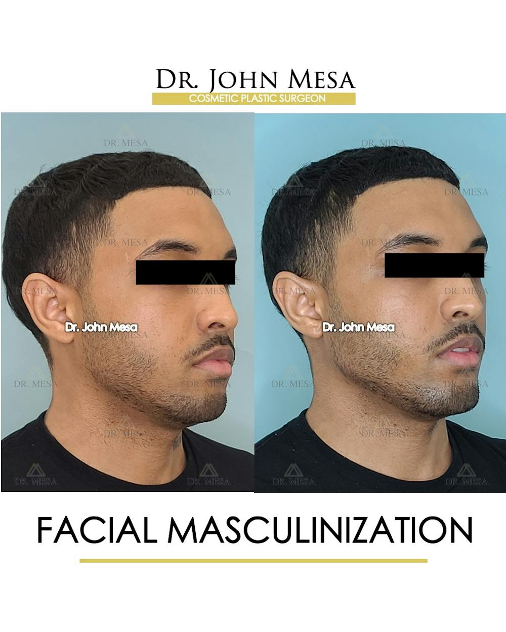 Facial Masculinization Before & After Gallery - Patient 148735313 - Image 2