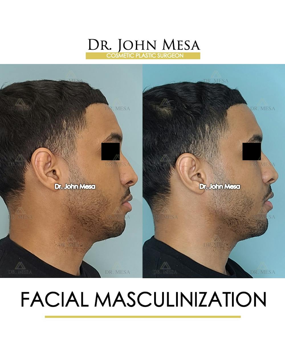 Facial Masculinization Before & After Gallery - Patient 148735313 - Image 3