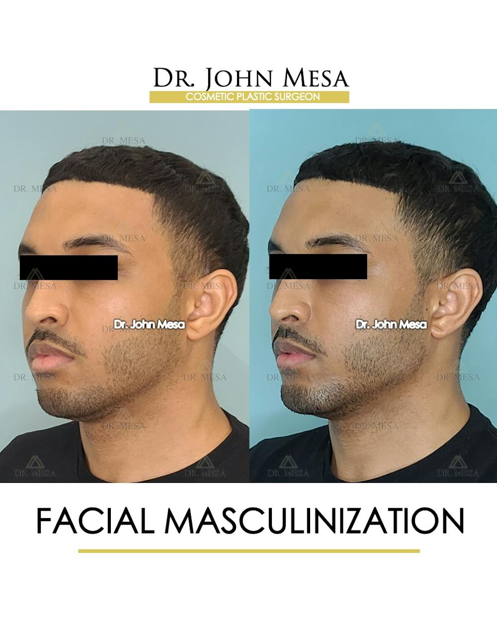 Facial Masculinization Before & After Gallery - Patient 148735313 - Image 4