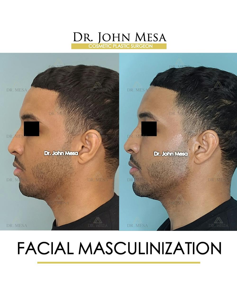 Facial Masculinization Before & After Gallery - Patient 148735313 - Image 5