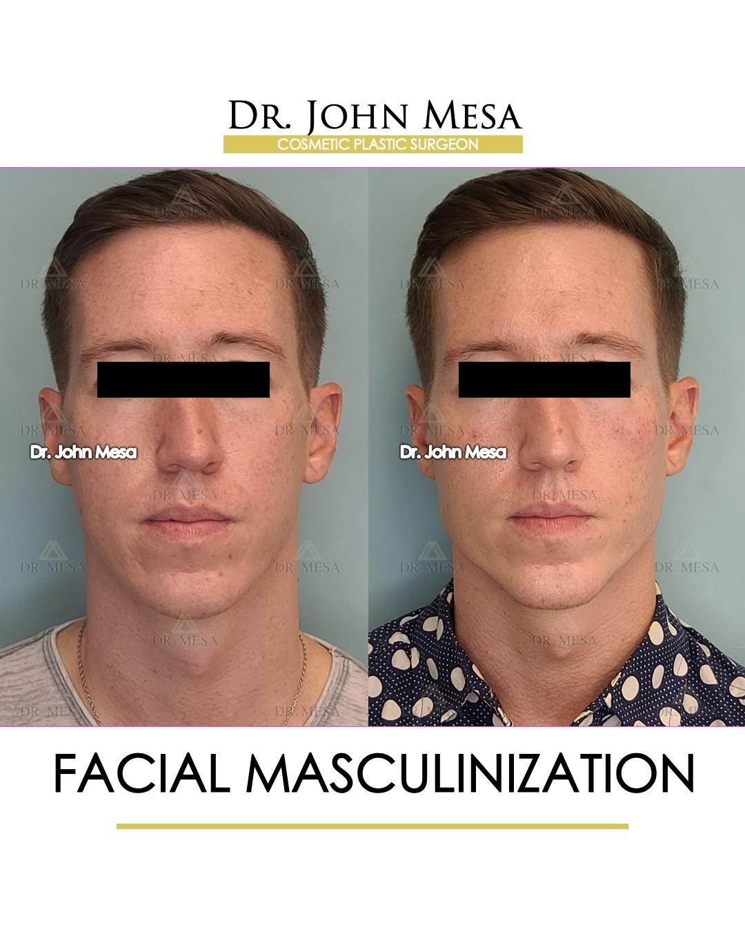 Facial Masculinization Before After Photos Dr Mesa Facial Masculinization Before After Photos Dr Mesa