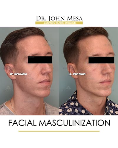 Facial Masculinization Before & After Gallery - Patient 148735314 - Image 2
