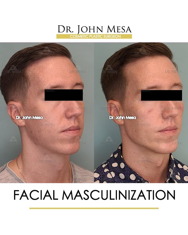 Facial Masculinization Before & After Gallery - Patient 148735314 - Image 2