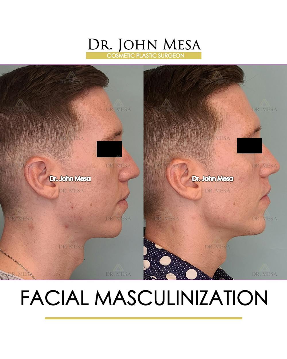 Facial Masculinization Before & After Gallery - Patient 148735314 - Image 3