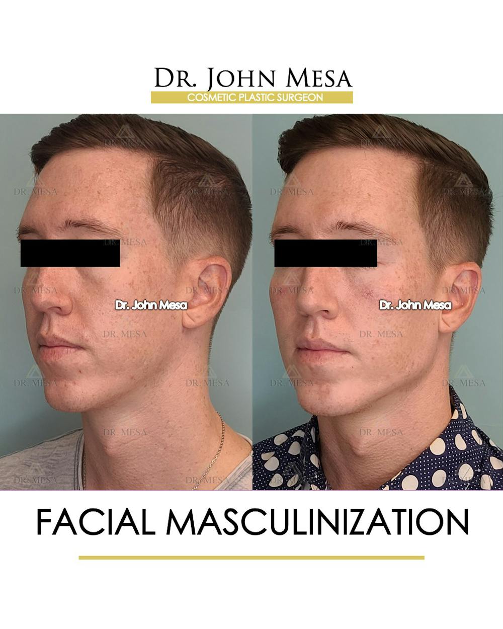 Facial Masculinization Before & After Gallery - Patient 148735314 - Image 4