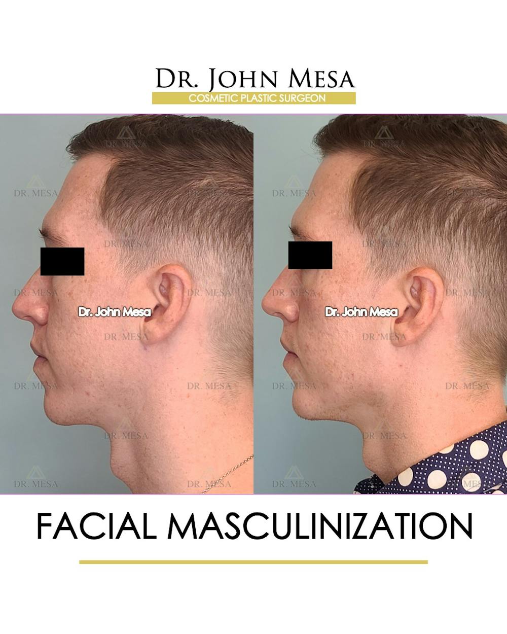 Facial Masculinization Before & After Gallery - Patient 148735314 - Image 5