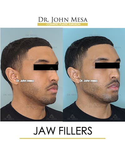 Fillers Before & After Gallery - Patient 148735339 - Image 2