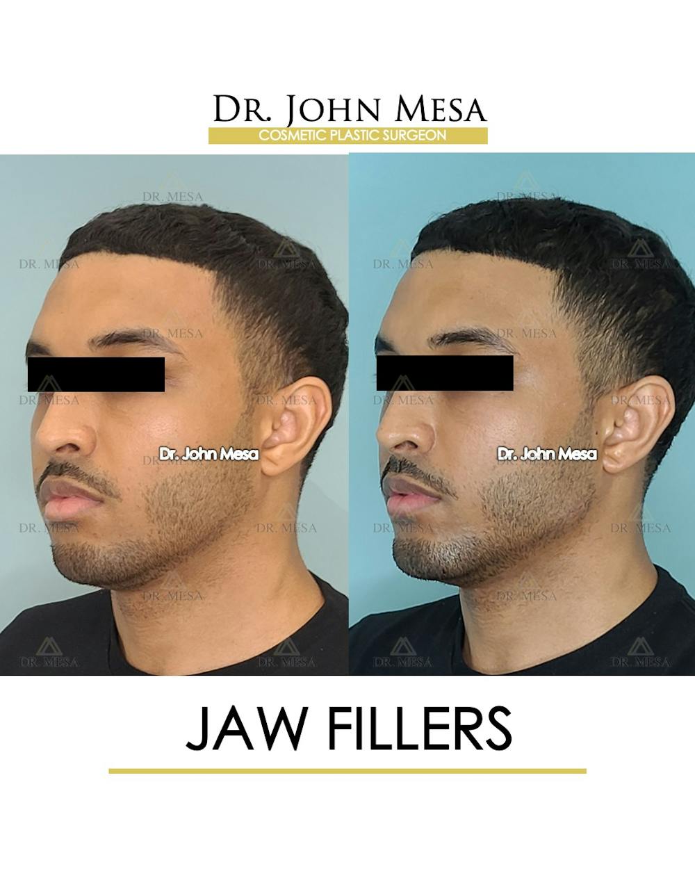 Jaw Filler Before & After Gallery - Patient 149284323 - Image 4