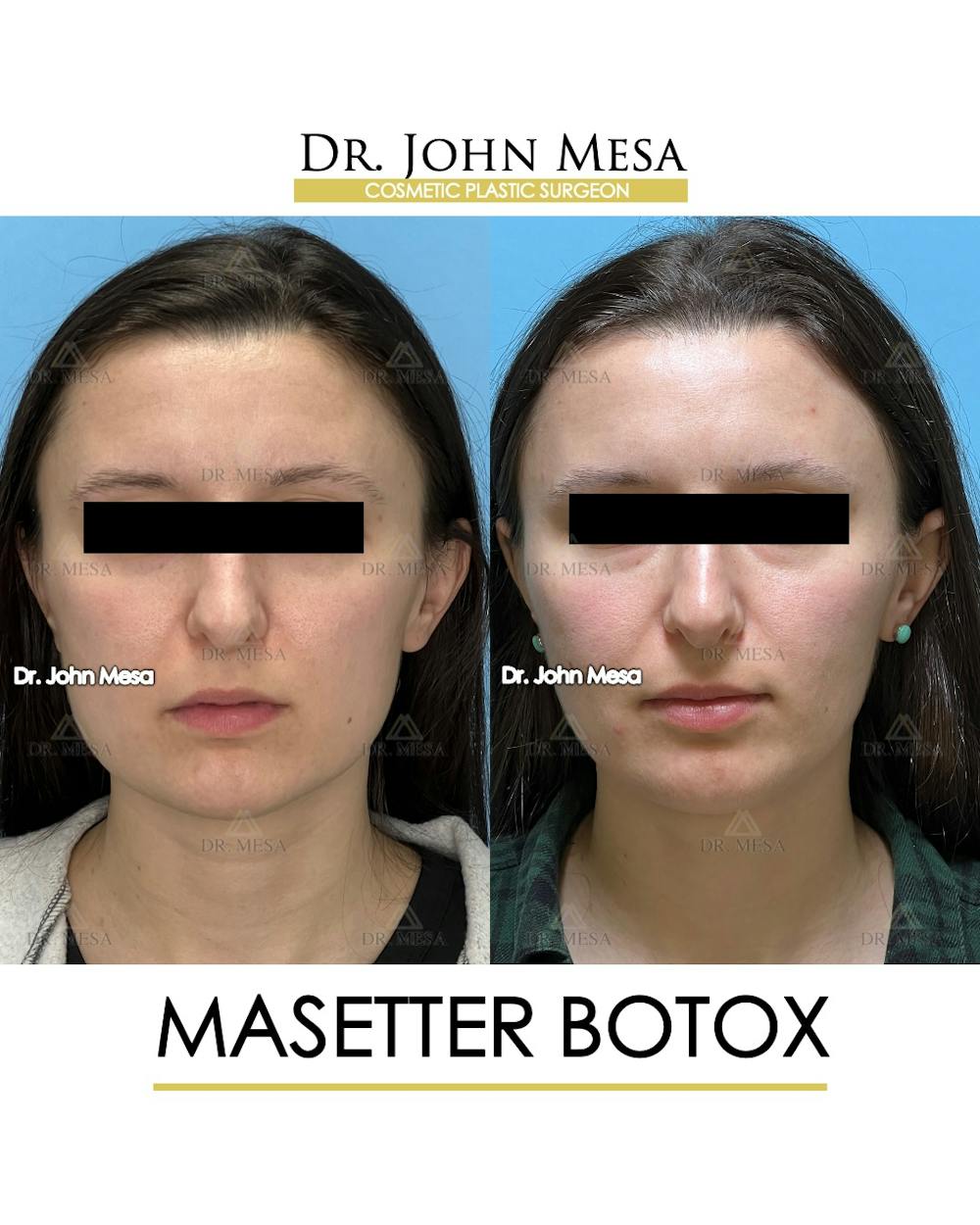 Botox