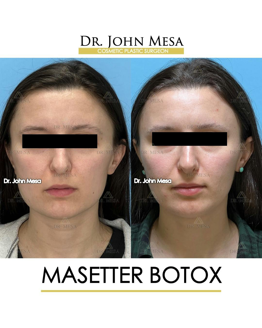 Botox Before & After Gallery - Patient 148735364 - Image 1