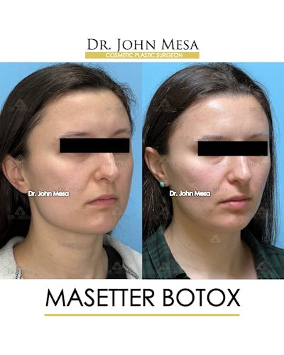 Botox Before & After Gallery - Patient 148735364 - Image 2