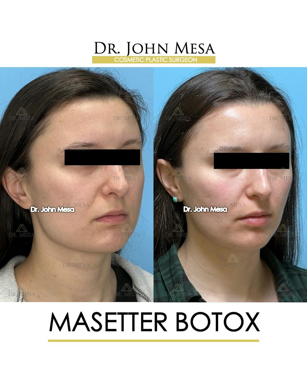 Botox Before & After Gallery - Patient 148735364 - Image 2