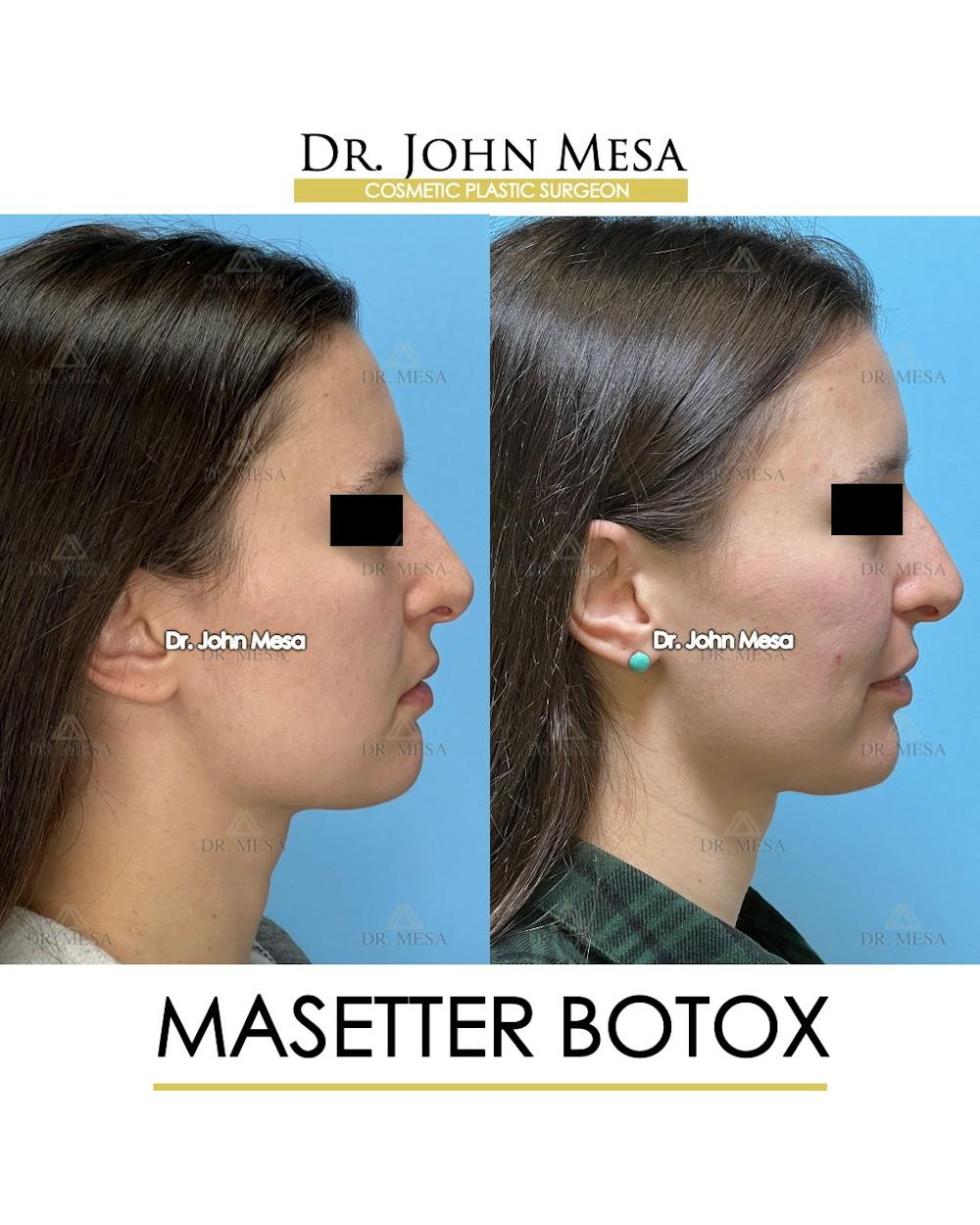 Botox Before & After Gallery - Patient 148735364 - Image 3