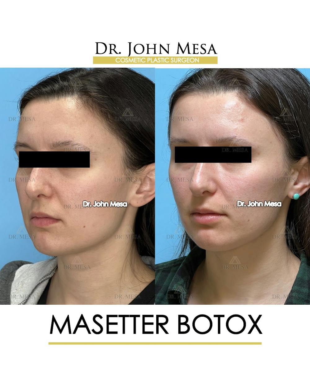 Botox Before & After Gallery - Patient 148735364 - Image 4