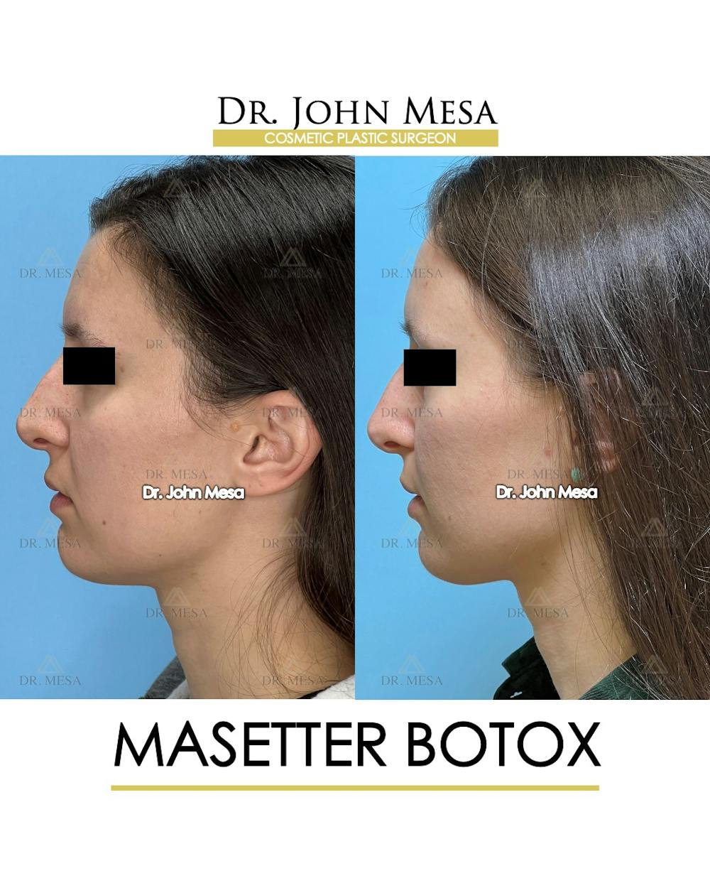 Botox Before & After Gallery - Patient 148735364 - Image 5