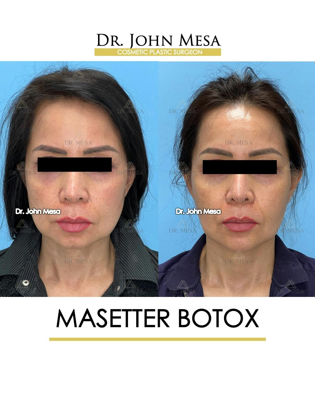 BOTOX Before & After Gallery - Patient 148735365 - Image 1
