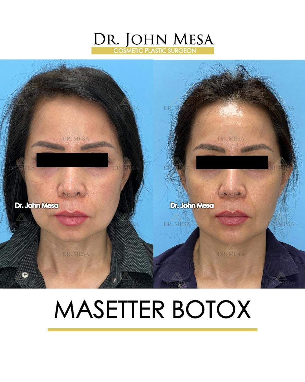 Botox