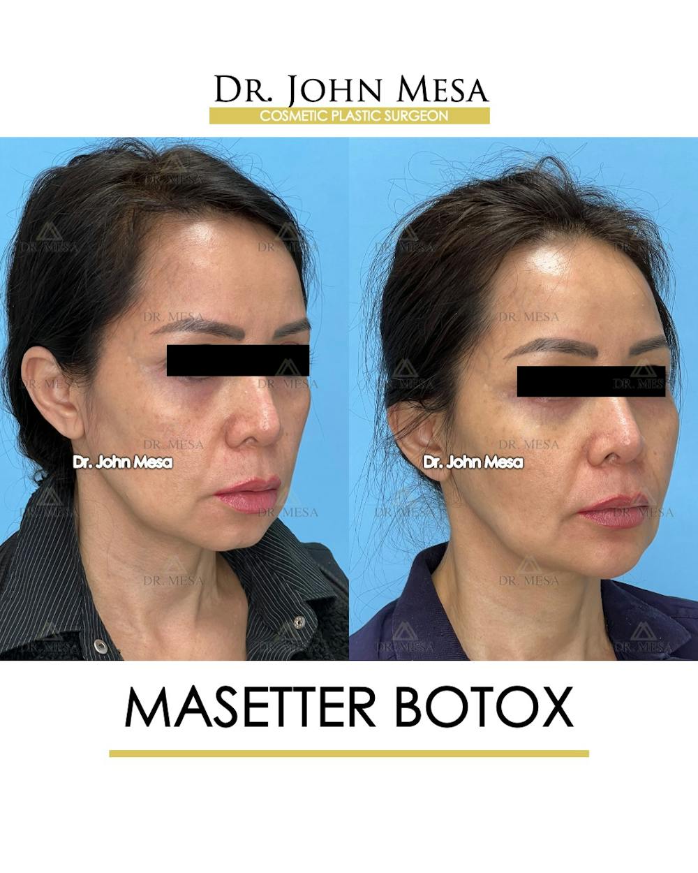 Botox Before & After Gallery - Patient 148735365 - Image 2