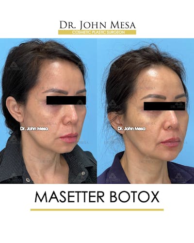 BOTOX Before & After Gallery - Patient 148735365 - Image 2
