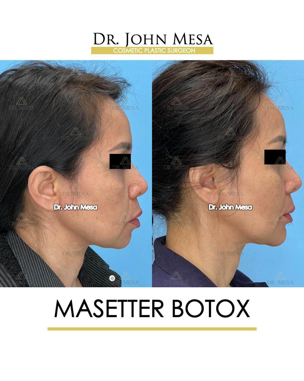 BOTOX Before & After Gallery - Patient 148735365 - Image 3