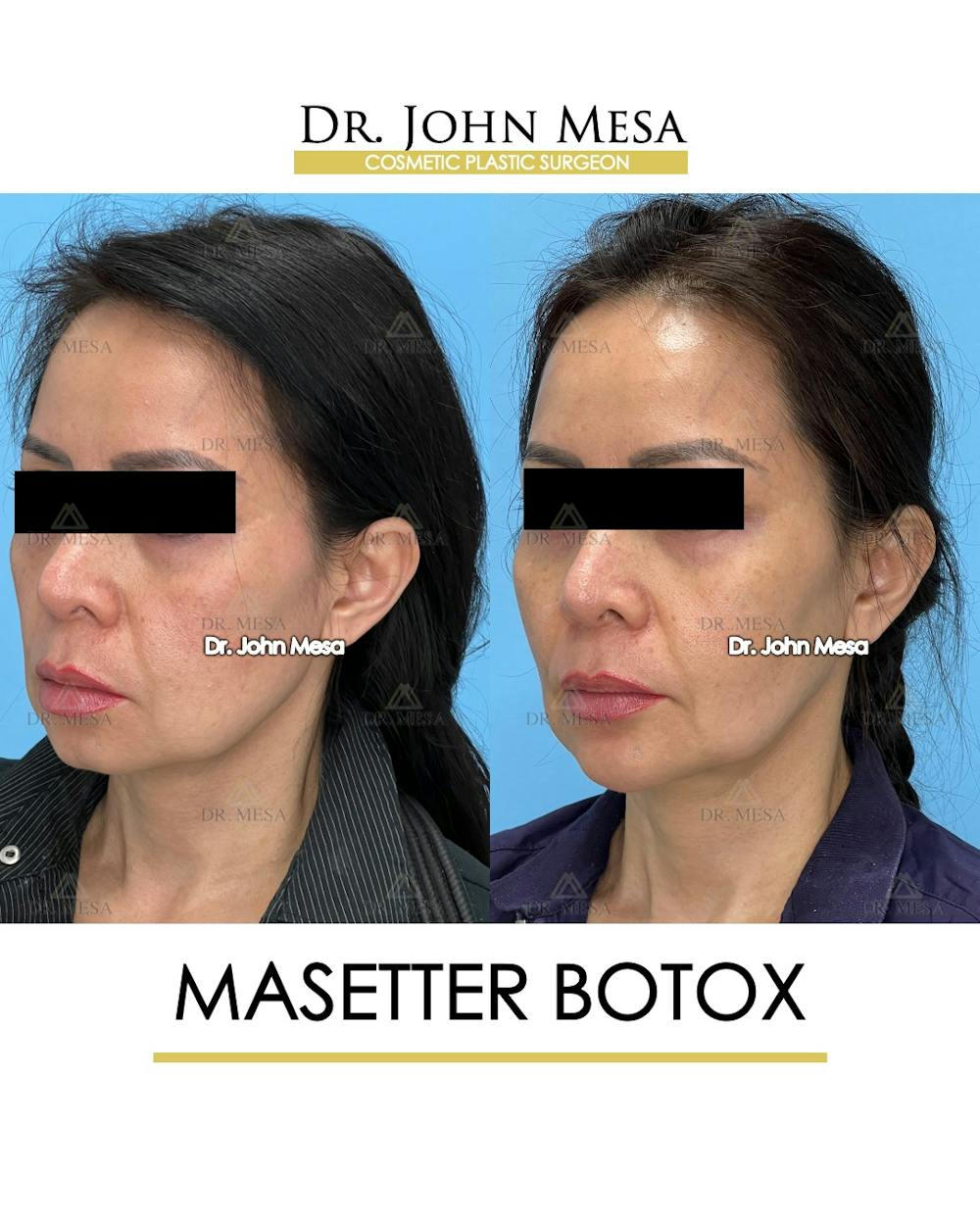 Botox Before & After Gallery - Patient 148735365 - Image 4