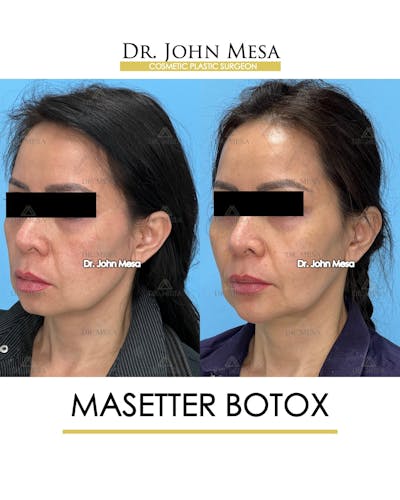 Botox Before & After Gallery - Patient 148735365 - Image 4