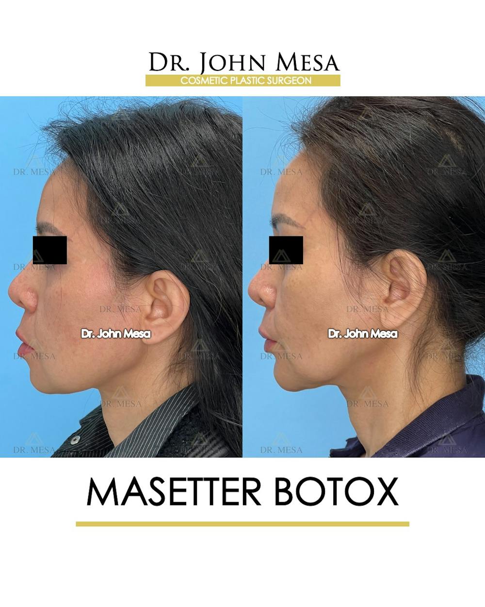 Botox Before & After Gallery - Patient 148735365 - Image 5