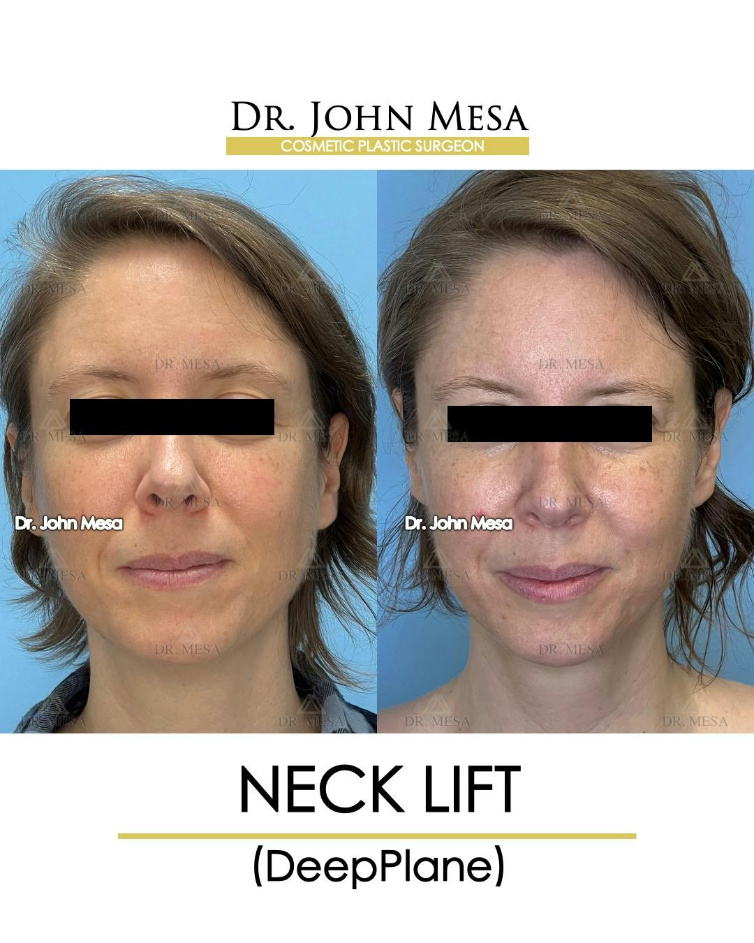 Neck Lift Before & After Gallery - Patient 148735375 - Image 1