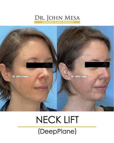 Neck Lift Before & After Gallery - Patient 148735375 - Image 2
