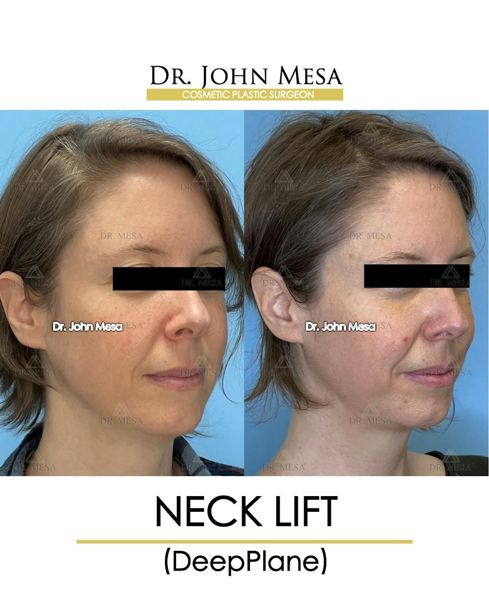 Neck Lift Before & After Gallery - Patient 148735375 - Image 2